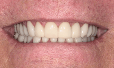 After treatment - Full-Mouth Dental Crowning
