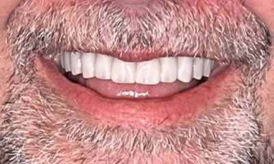 After treatment - Full-Mouth Implant Rehabilitation with Final Hybrid Prostheses