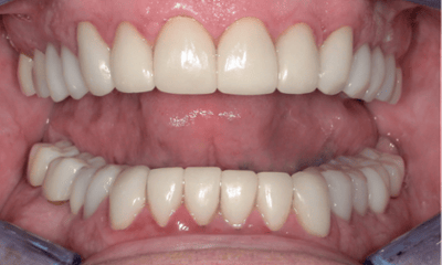 After treatment - Full-Mouth Dental Crowning