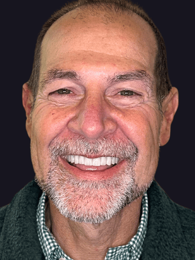 After treatment - Full-Mouth Implant Rehabilitation with Final Hybrid Prostheses
