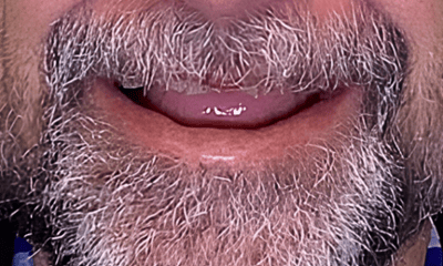 Before treatment - Full-Mouth Implant Rehabilitation with Final Hybrid Prostheses