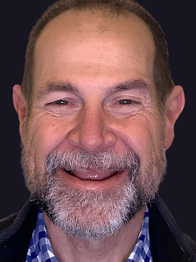 Before treatment - Full-Mouth Implant Rehabilitation with Final Hybrid Prostheses